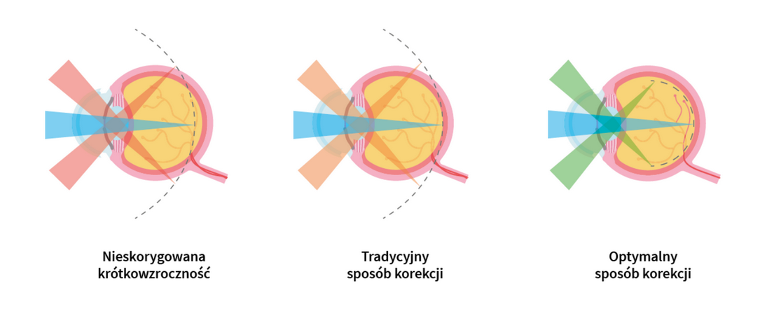 Optyk Wrocław - Tęczówka